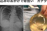 【画像】豊胸手術をすべき理由