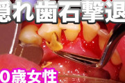 女の子の歯石を取るだけの動画、なぜか2ヶ月で3569万回も視聴されてしまう