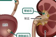 尿路結石とかいう名前からは想像もつかない地獄のような苦痛を味わう病気