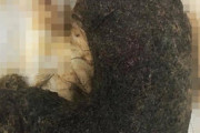【閲覧注意】抜毛症の11歳女児の胃から「巨大毛玉」が摘出される