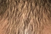【悲報】ワイ（27）の頭皮、限界か…（※画像あり）
