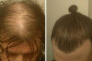【朗報】ハゲを隠せる髪型、見つかる