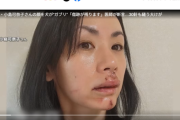 【悲報】女性タレント、犬に噛まれ30針縫う大けがを負い「傷だらけの顔」を投稿する…