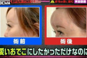 【悲報】整形に失敗した女さん、おでこが大変なことになってしまうｗｗｗｗｗ