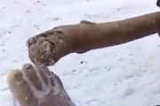 【動画】凍傷を負った14歳の少年の足、内部まで完全に凍ってしまう。