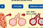 死ぬより苦しい「肺炎」の真実がヤバすぎる・・・