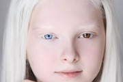 【画像】アルビノとオッドアイを併発した少女ｗｗｗｗｗ