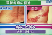 【緊急】帯状疱疹 6日目、死にそう