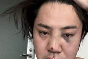 人気YouTuber 素潜り漁師マサル、深夜の東京でボッコボコにされて大量出血