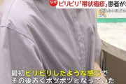 「眠れないほどの痛み」“帯状疱疹”の患者増加　20代でも発症…医師「暑くなり免疫低下、若い人にも増える傾向」