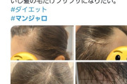 【画像】ダイエット目的でマンジャロを使用していたまんさん、ハゲ始める