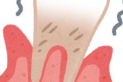 【悲報】どんだけ頑張って歯磨きしても歯周病が止まらない