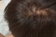 【画像】ハゲ薬飲み始めて1年以上経った結果ｗｗｗｗｗｗｗｗｗｗｗｗｗｗ