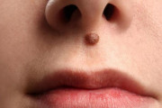 【ヤバイ】鼻の下にあるホクロ、巨大化して穴をふさぎ、呼吸困難に陥る可能性