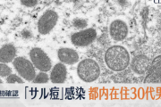 【終焉】サル痘、日本上陸