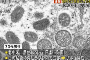【速報】サル痘　２例目　また男性ｗｗｗｗｗｗｗｗｗｗｗｗｗｗｗｗｗｗ