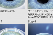 【議論】レーシック手術を受けた結果、強烈に視力が回復！