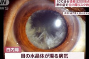 【どうなｎ？】熱中症白内障リスク4倍　水晶体のタンパク質が熱で変性　　じゃあサウナもヤバイんか？