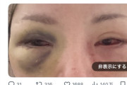 【画像】女さん　整形手術で片目を失明・・・・・