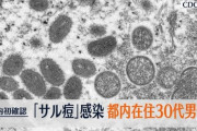 【感染したら二次被害も】サル痘　日本でも初の感染者　都内在住30代男性