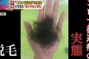 【やはりヤバイ】コロナ脱毛、なんと6割以上が改善なし・・・年齢関係なく抜けまくり　ただの心因性じゃなかったのかよ！