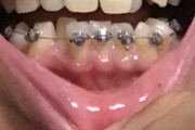 歯の矯正始めた（※画像あり）