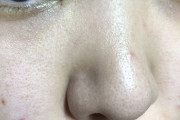 【画像】毛穴ボツボツやばいから毛穴パックする