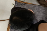 【画像あり】AGA治療はじめて２年が経った