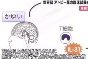 【大朗報】アトピー性皮膚炎の「かゆみの発生を抑える薬」臨床試験に成功　京都大学で世界初