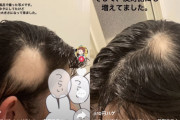 コロナ後遺症でハゲ散らかしたJK、むせび泣く 「ハゲでも愛せ」