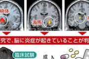 【朗報】慢性疲労症候群の薬、開発まであと少し『治療法の確立まで5合目まで来た』