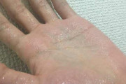 【画像】『多汗症』とかいう夏でも冬でも苦しむ病気ｗｗｗｗｗｗｗ