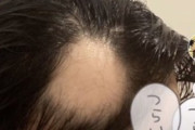 【悲報】コロナを舐めてた女性、続々とハゲ始めて絶望へ…