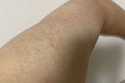 俺の二の腕ブツブツ過ぎワロタｗｗｗ（※画像あり）