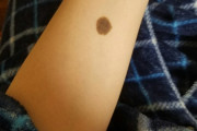 【画像】腕に変なほくろが出来た