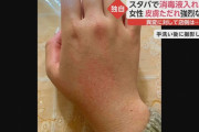 【悲報】スタバの消毒液を使った客、皮膚がただれてしまう