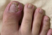 【閲覧注意】足の指がとんでもない腫れ方してる（※画像あり）