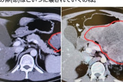 【悲報】末期がん患者の癌、3ヶ月でとんでもない大きさに急成長する