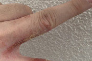 【悲報】アトピー持ちワイ、指が腐る
