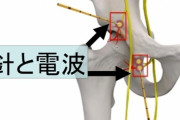 「電波」で関節痛を取り去る方法が発表される！