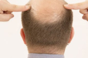 【意外な結果】ハゲに対する『女性の本音』408人に聞いてみた結果 ⇒