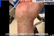 【悲報】コロナワクチン接種した奴、ヤバい症状が増えてる模様・・・