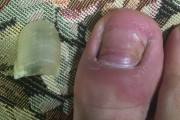 【衝撃画像】ワイの親指の爪、剥がれる