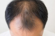 【日本が世界初の快挙】わずかな細胞から数百本の髪を量産！薄毛治療に大革命をもたらす！