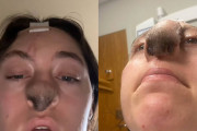 犬に鼻を噛まれた女性、頭皮を皮膚移植したら鼻先から毛が生えてきてしまう