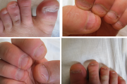 【画像】ガキの頃から両手足の爪を噛みまくった結果 → 取り返しがつかない状態に…
