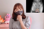 【悲報】大事故映像が話題になった女子ライダーYouTuber、人工関節の後遺症が残る模様