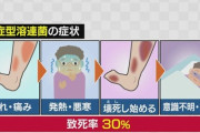 【致死率３０％】人喰いバクテリア・溶連菌感染症のニュースに対して医者「抗生物質も抗菌薬も足りてない」
