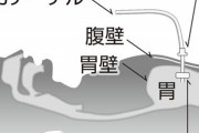 高齢者が誤嚥死したら介護施設を訴えれば２０００万円超が貰える状況に介護医療業界が震撼「老人は全員両手拘束して胃ろうにしなければ」