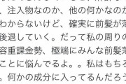 【悲報】顔を整形した女性、ハゲることが判明する